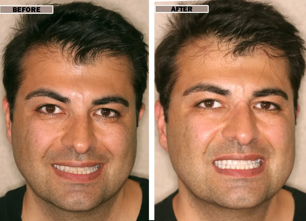 27915 smile direct whitening application