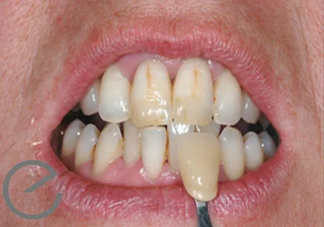 /img/27927-long-term-teeth-whitening.webp