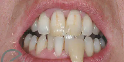/img/27927-long-term-teeth-whitening.webp