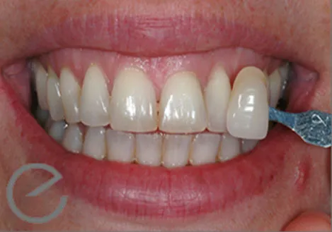 27927 teeth whitening confidence