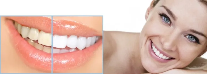 27941 teeth whitening comparison
