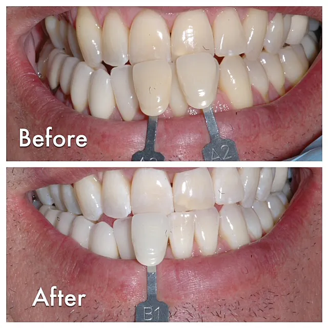 27944 teeth whitening before after