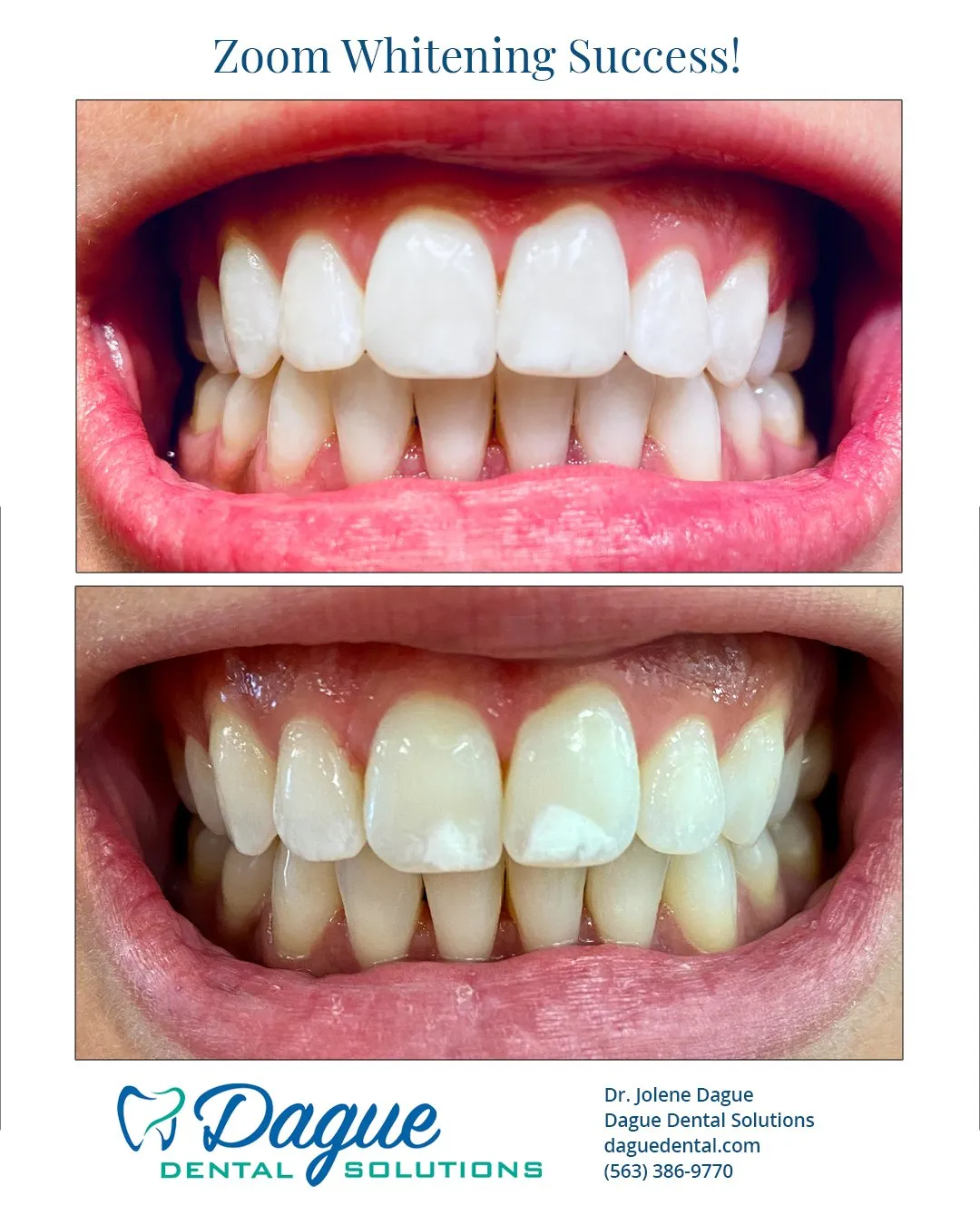 27946 teeth whitening peroxide 6