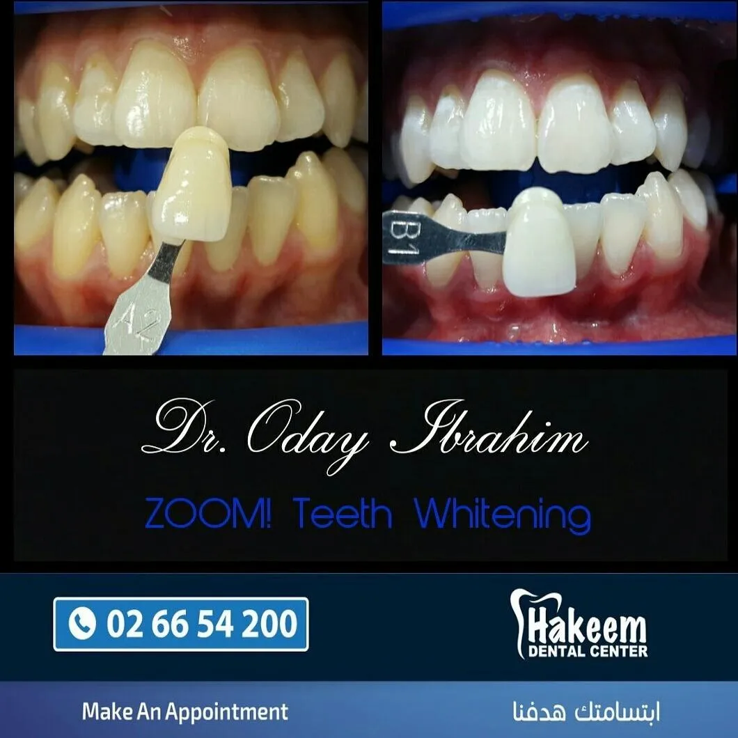 27950 zoom whitening benefits