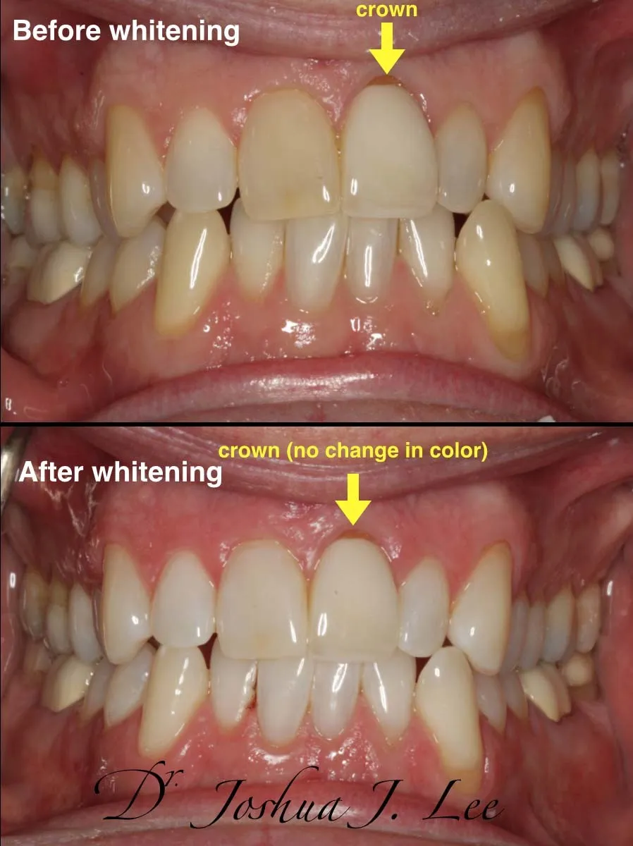 27950 zoom whitening procedure