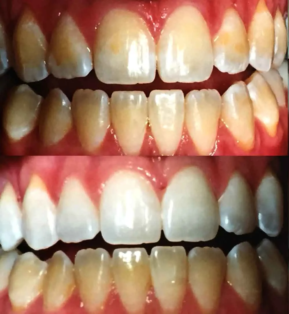 27955 teeth whitening upper east side 5