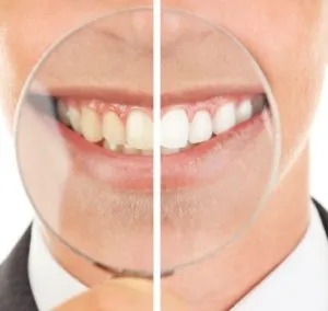 27959 professional teeth whitening