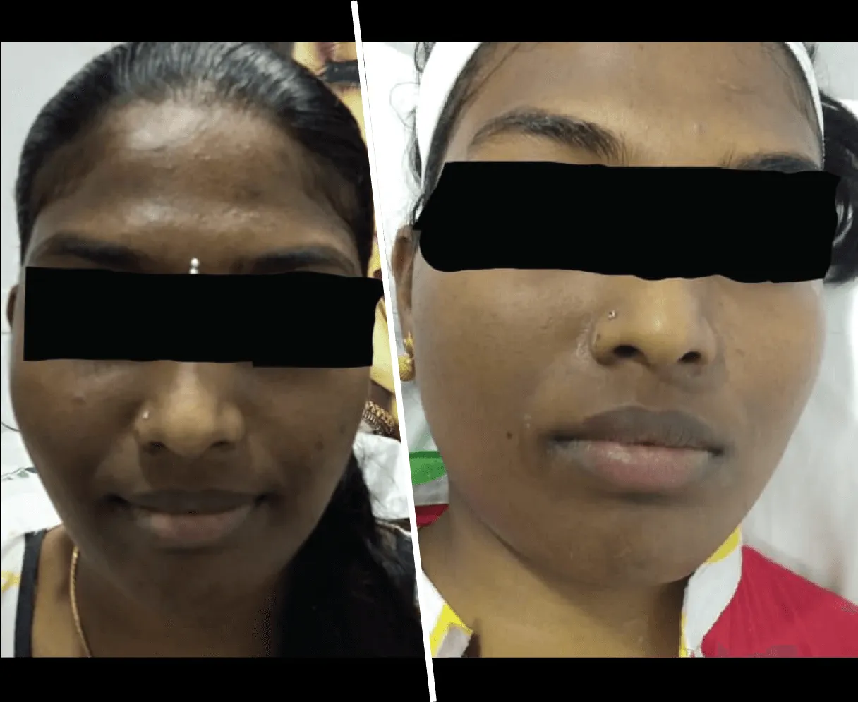 27960 chemical peel treatment