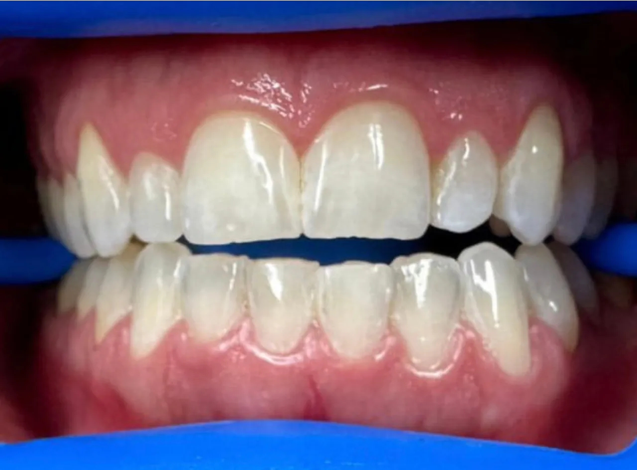 /img/27967-teeth-whitening-syracuse-ny-image8.webp
