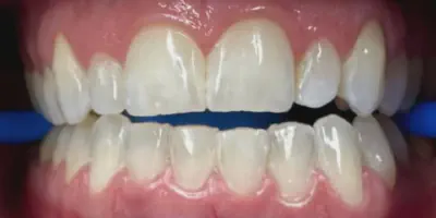 /img/27967-teeth-whitening-syracuse-ny-image8.webp