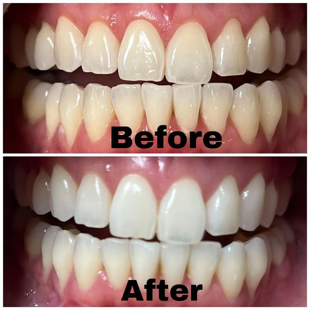 27974 professional teeth whitening