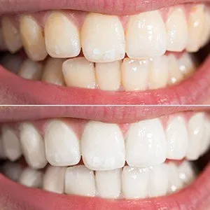 27976 teeth whitening costa mesa 5