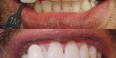 /img/27976-teeth-whitening-costa-mesa-7.webp