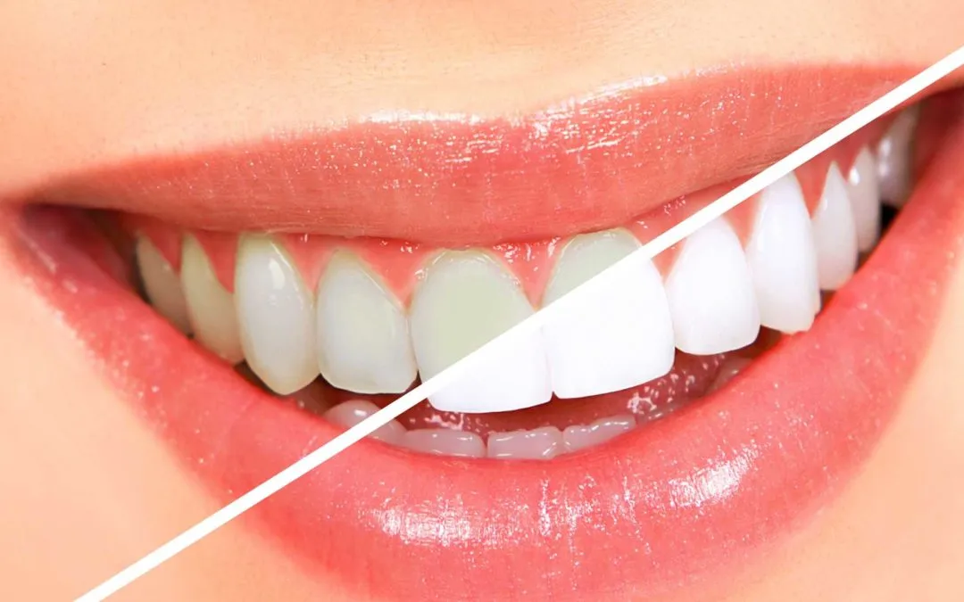 27980 teeth whitening pain 4