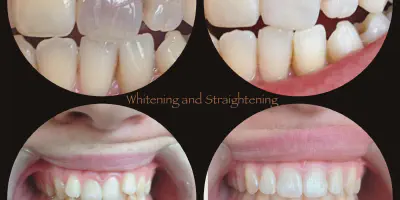 /img/27980-teeth-whitening-pain-7.webp