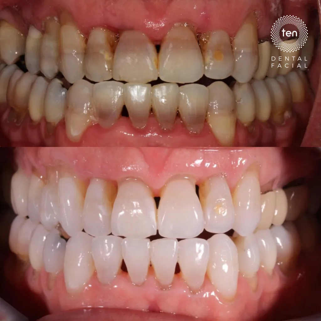 27990 tooth sensitivity after whitening
