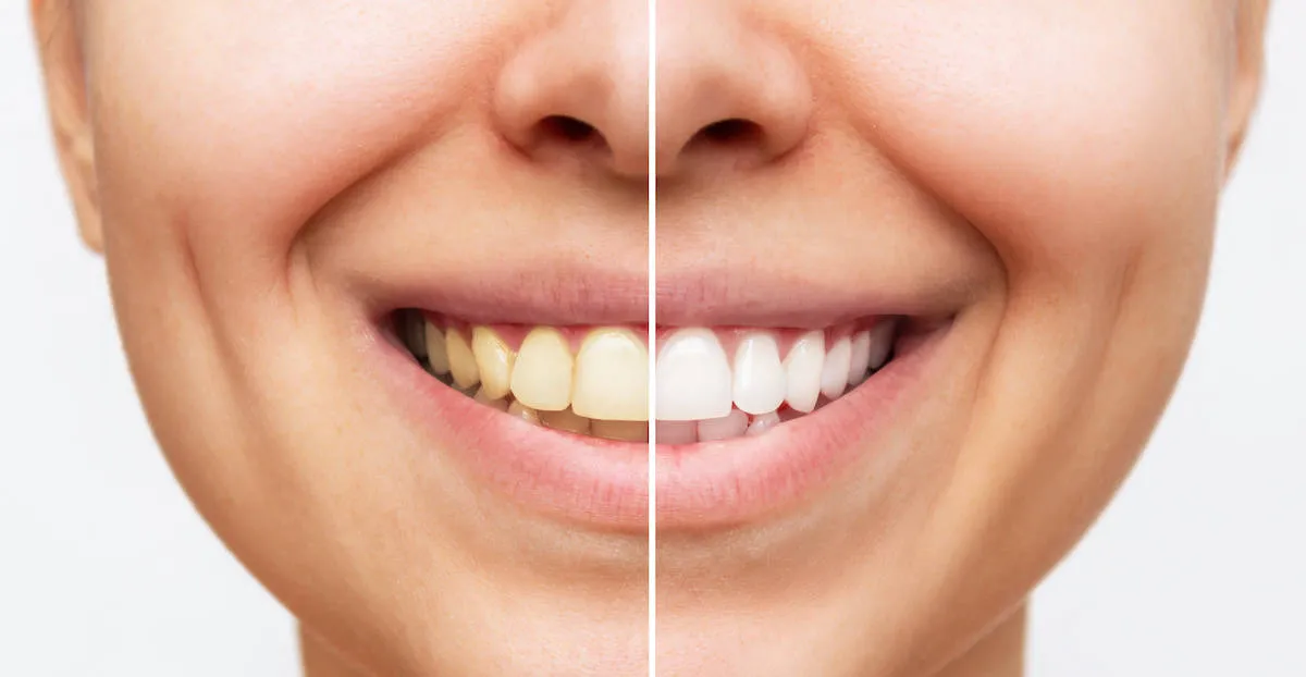 27995 teeth whitening consultation