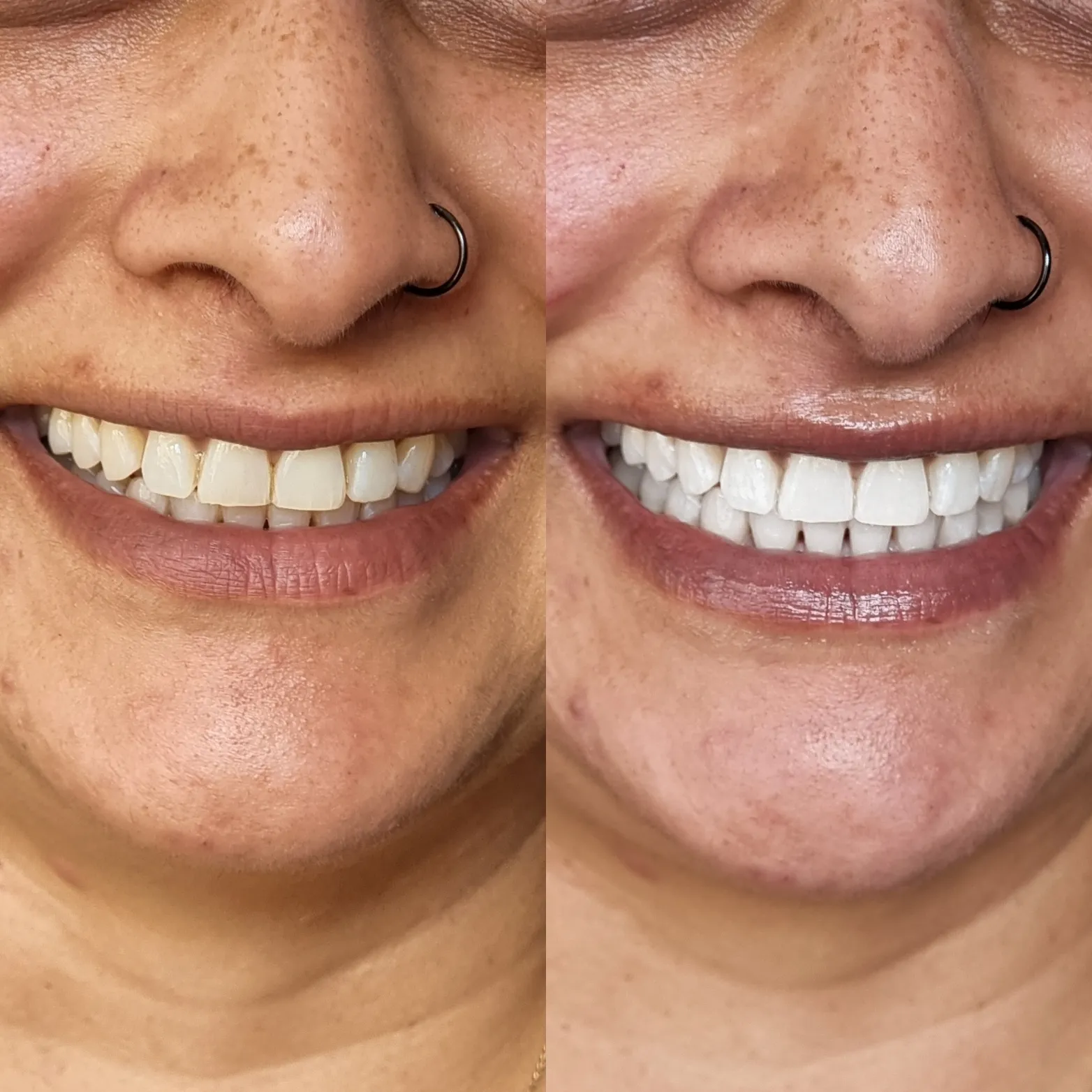 28005 teeth whitening milwaukee before after