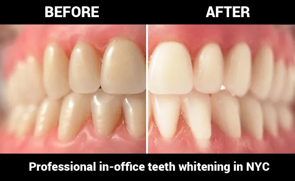 28006 teeth whitening systems