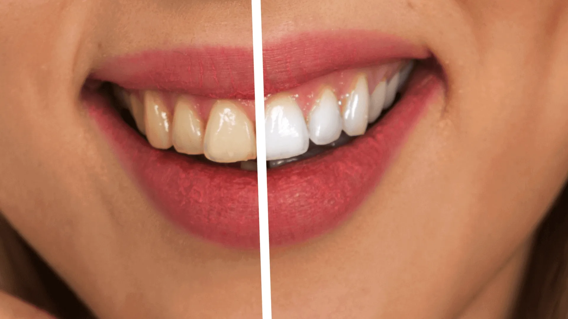 28008 teeth whitening sensitivity