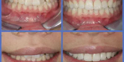/img/28010-comparing-teeth-whitening.webp