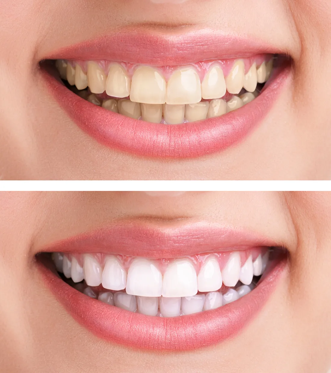 28012 at home teeth whitening cary nc