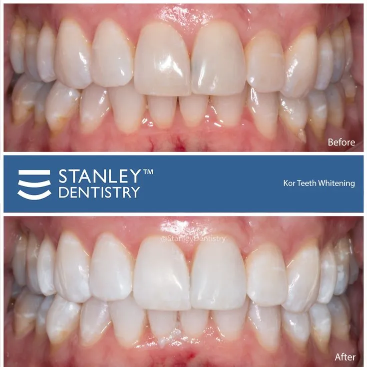 28012 dentist cary nc teeth whitening