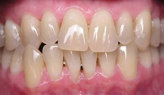 28012 professional teeth whitening cary nc