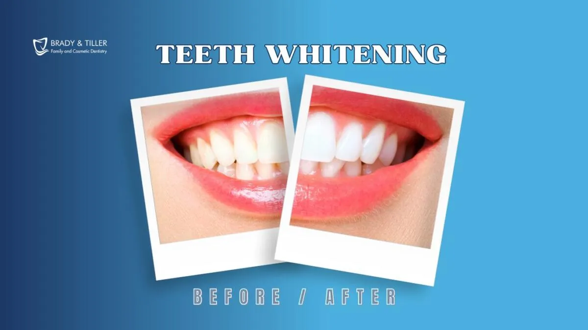 /img/28012-teeth-whitening-cary-nc-procedure.webp