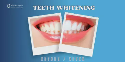 /img/28012-teeth-whitening-cary-nc-procedure.webp