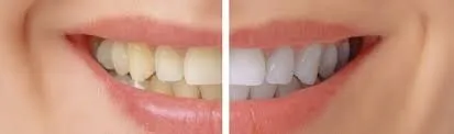 28014 arizona teeth whitening smile