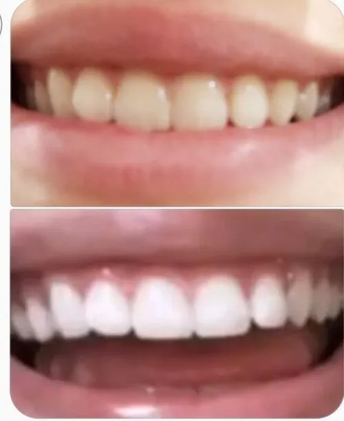 28014 in office teeth whitening