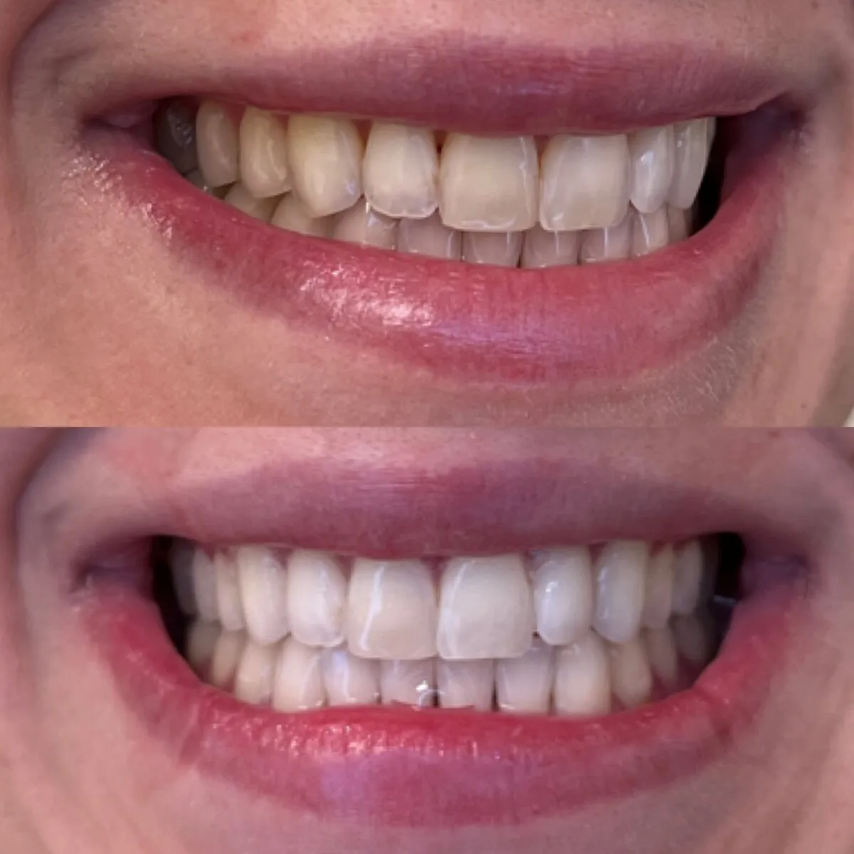 28022 tooth whitening portland or 1