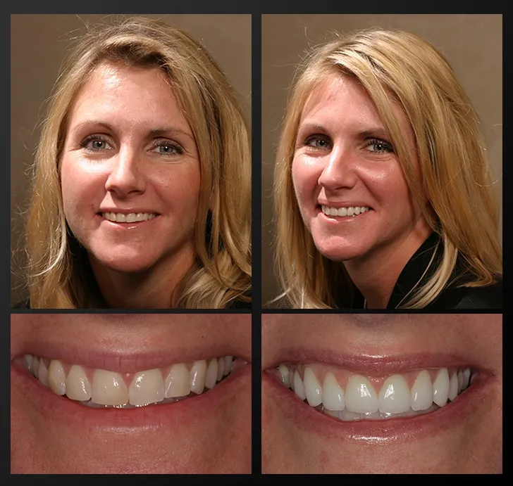 /img/28029-teeth-whitening-results.webp