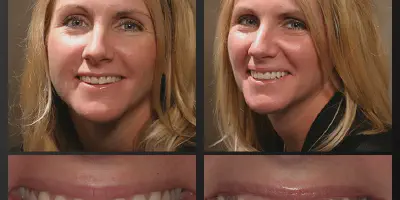 /img/28029-teeth-whitening-results.webp