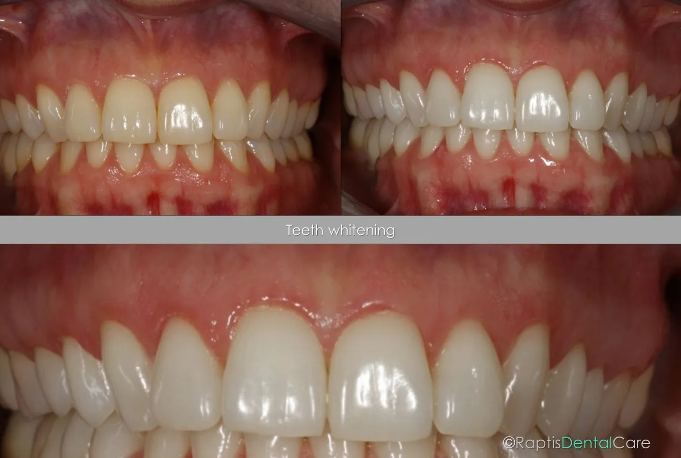28036 at home teeth whitening fethiye