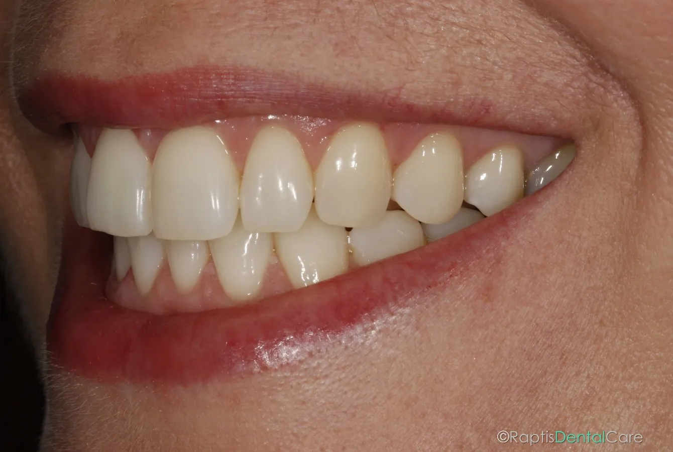 28036 professional teeth whitening fethiye
