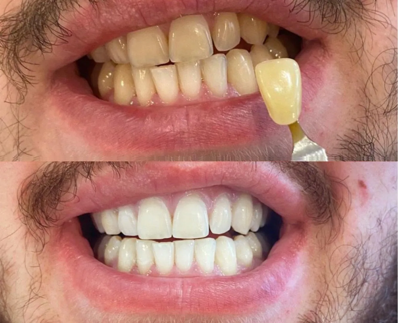 28036 teeth whitening fethiye before after