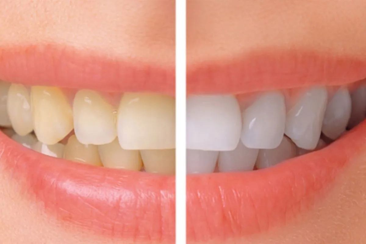 /img/28036-teeth-whitening-fethiye-cost.webp