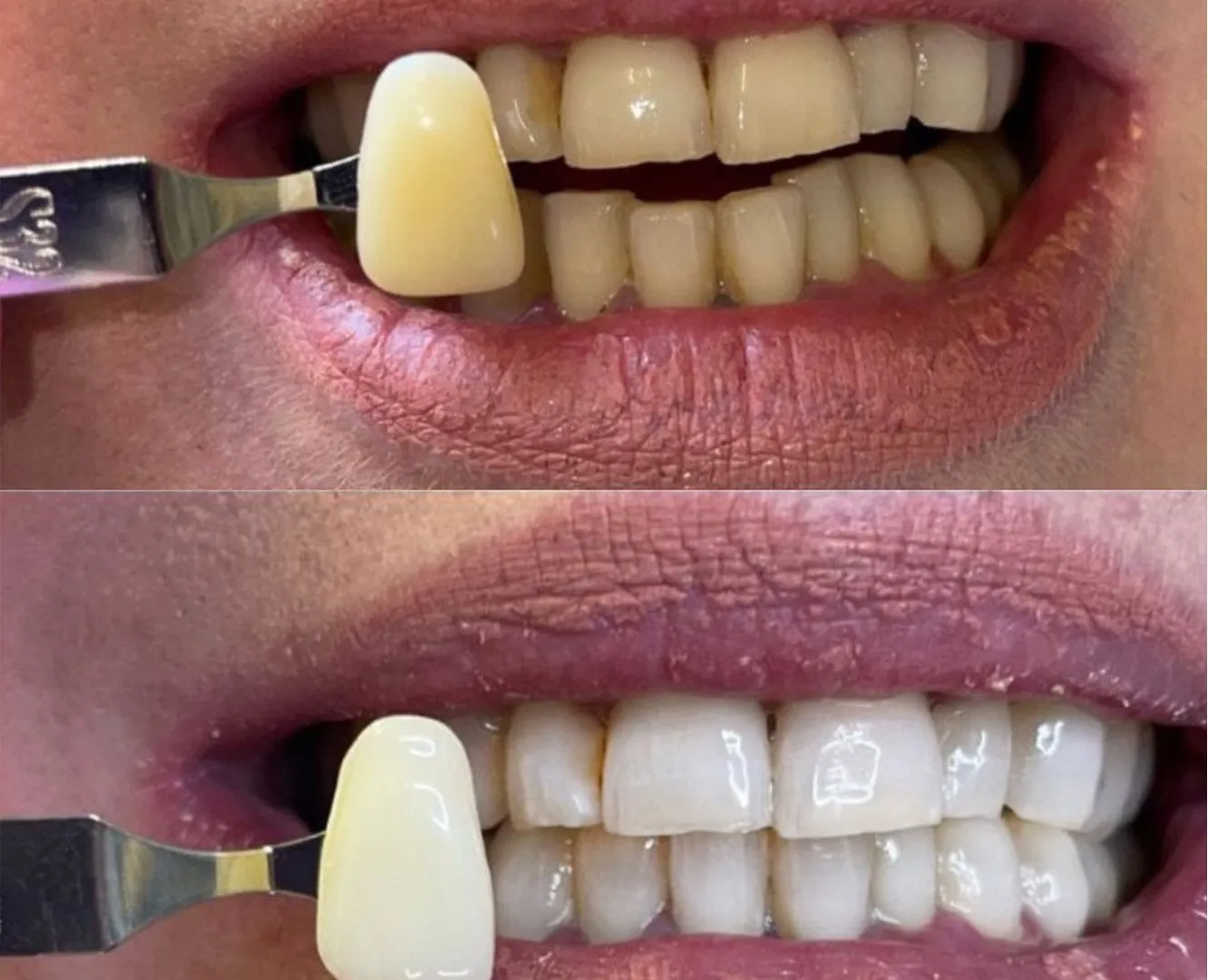 28036 types teeth whitening fethiye