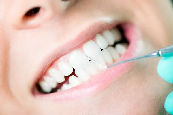 28038 teeth whitening cost