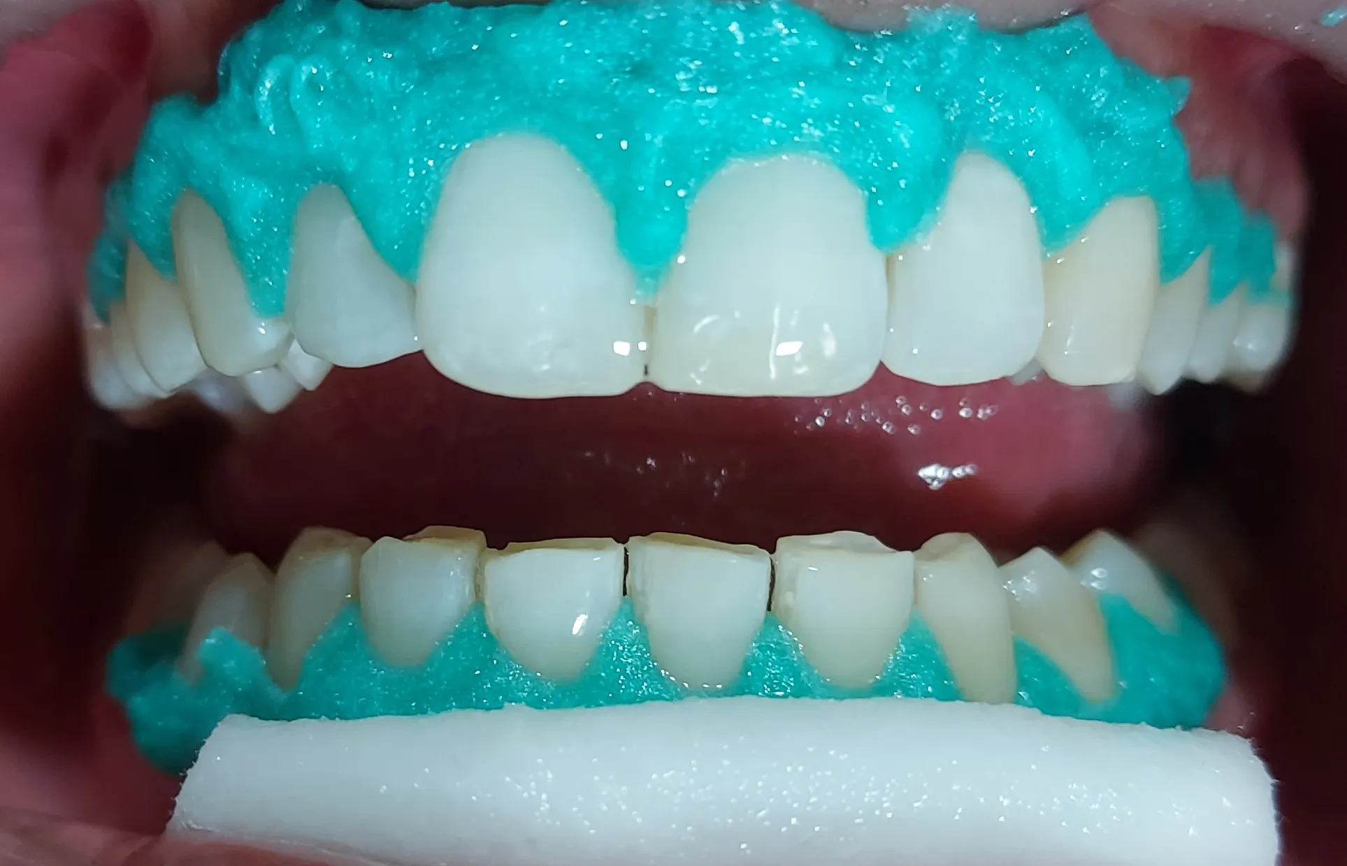 28040 root canal teeth whitening at home