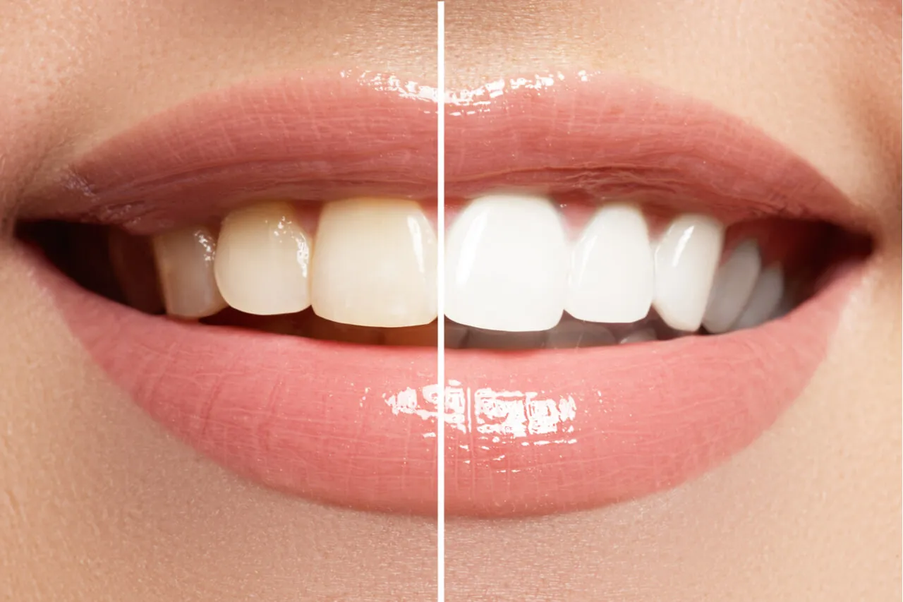 /img/28040-root-canal-teeth-whitening-risks.webp