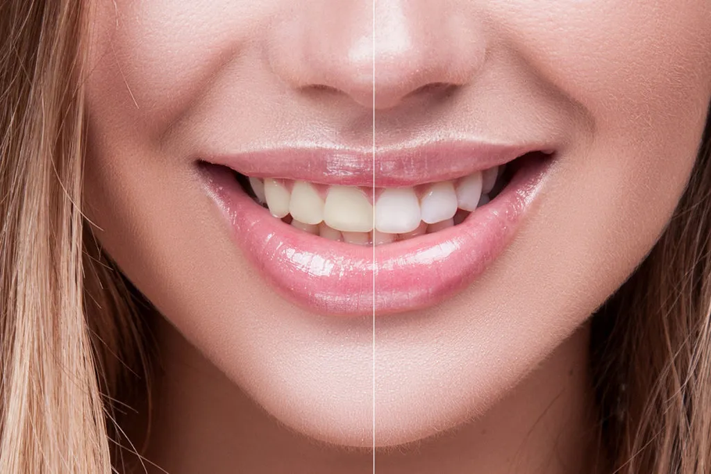 28042 teeth whitening manchester reviews