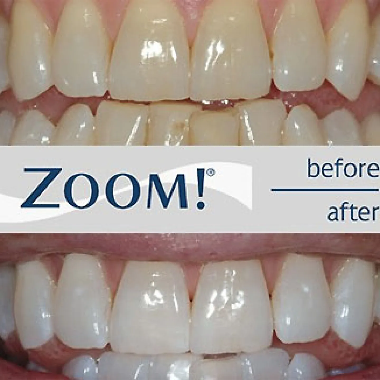 28047 zoom teeth whitening las vegas smile