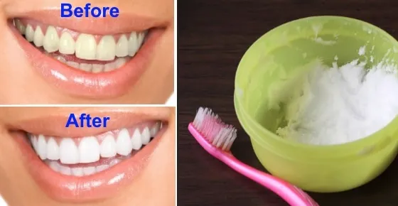 28054 teeth whitening guide