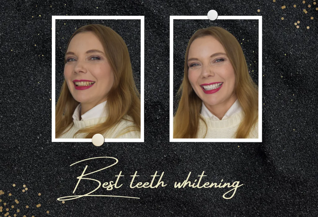 28056 teeth whitening at dentist 6