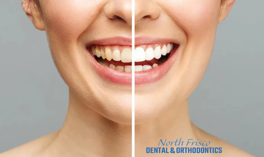 /img/28056-teeth-whitening-at-dentist-7.webp