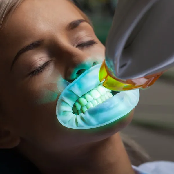 28057 professional teeth whitening