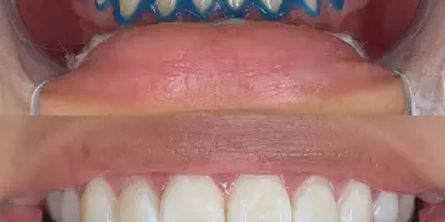 /img/28057-teeth-whitening-procedure.webp